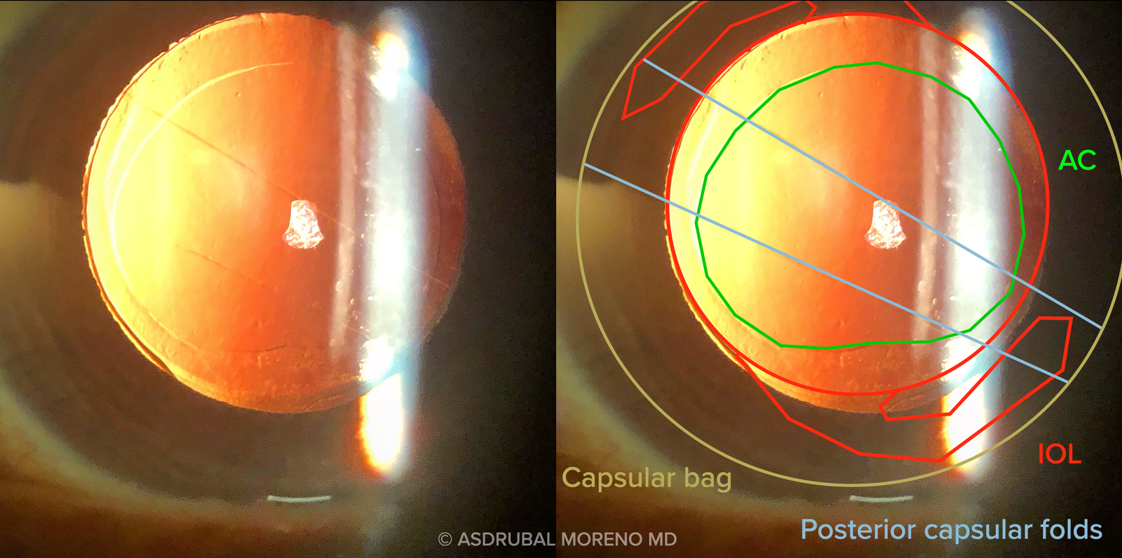 Pliegues capsulares