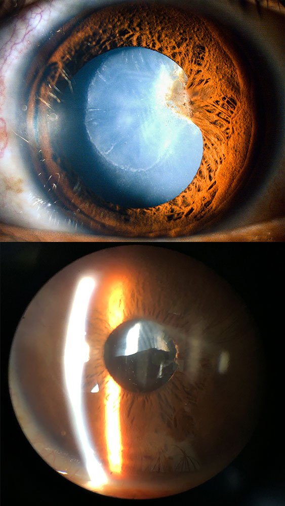 Fibrosis capsular perseverante