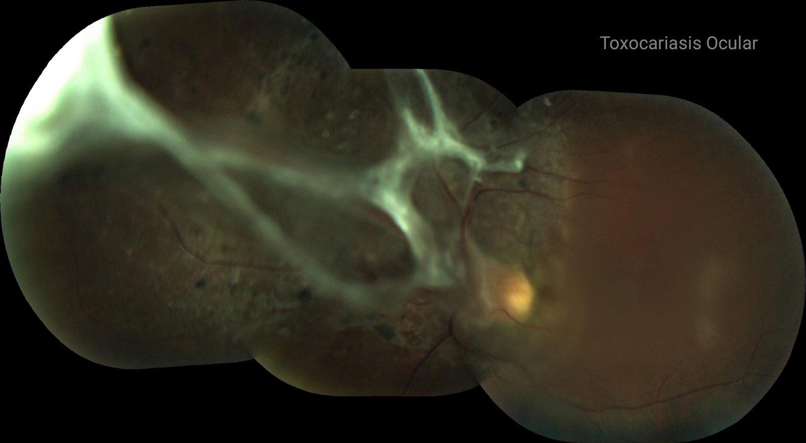 Toxocariasis ocular