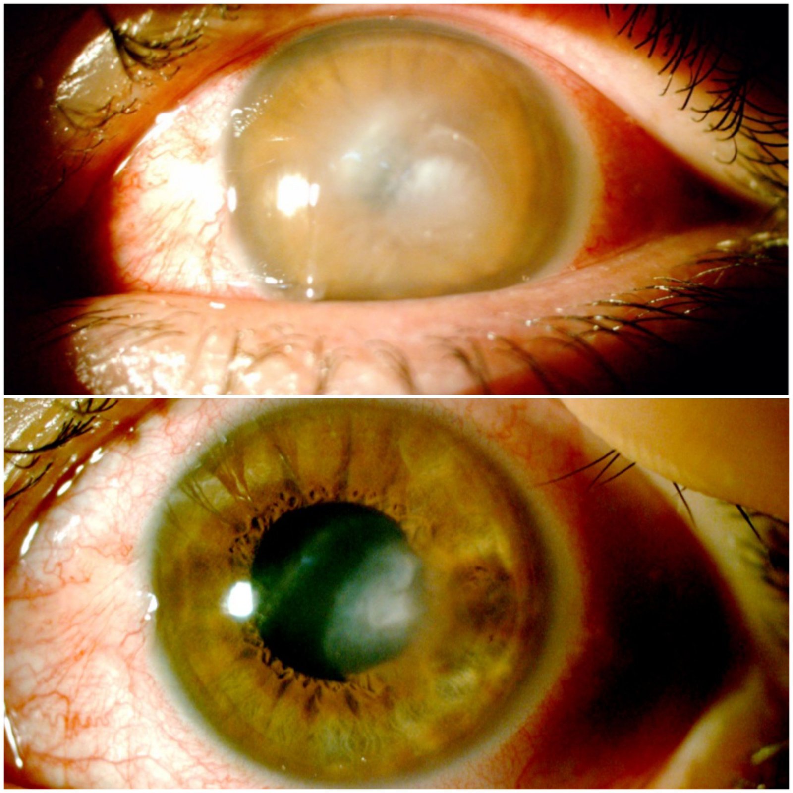 Úlcera Corneal Bacteriana