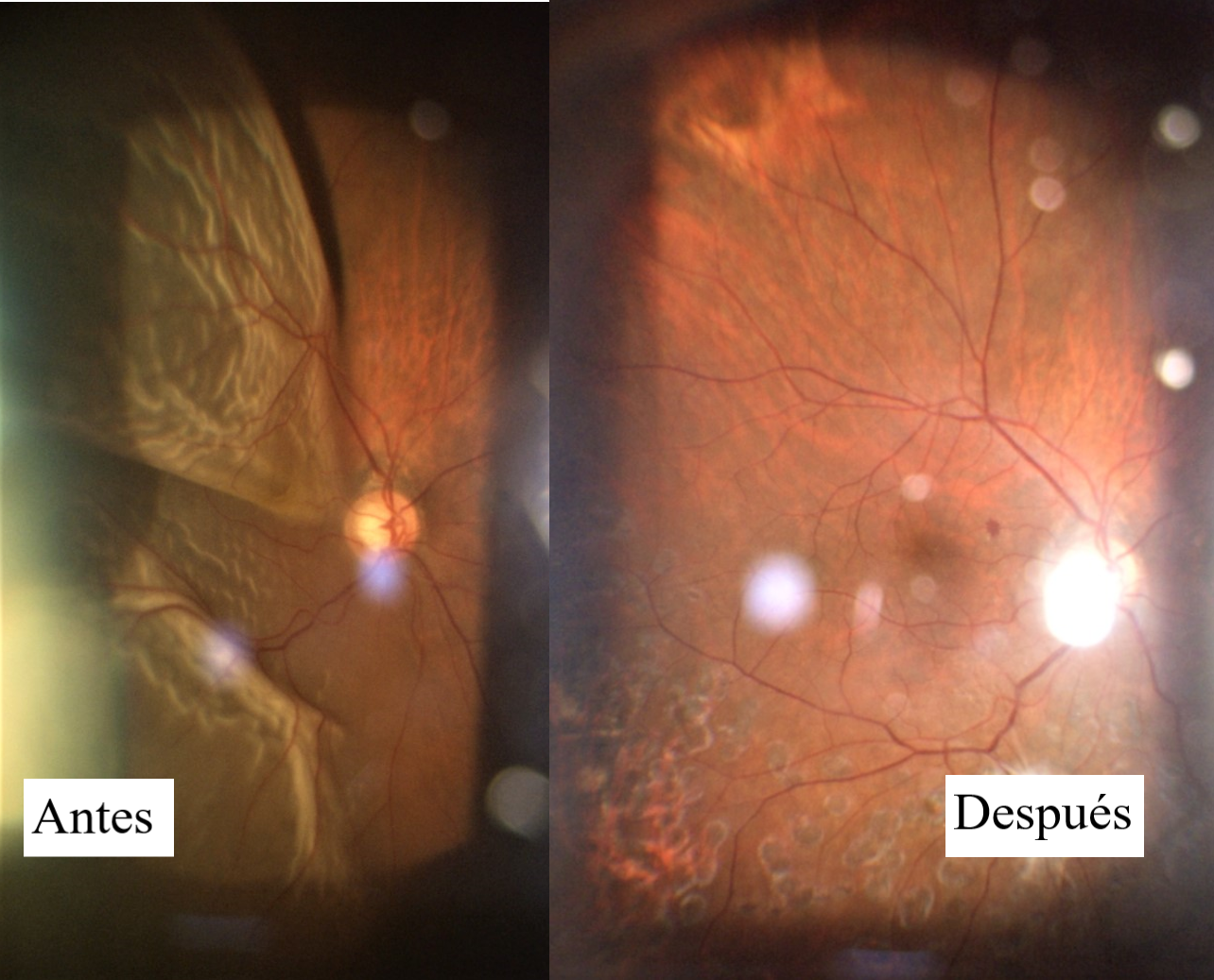Desprendimiento de Retina Regmatógeno + Glaucoma