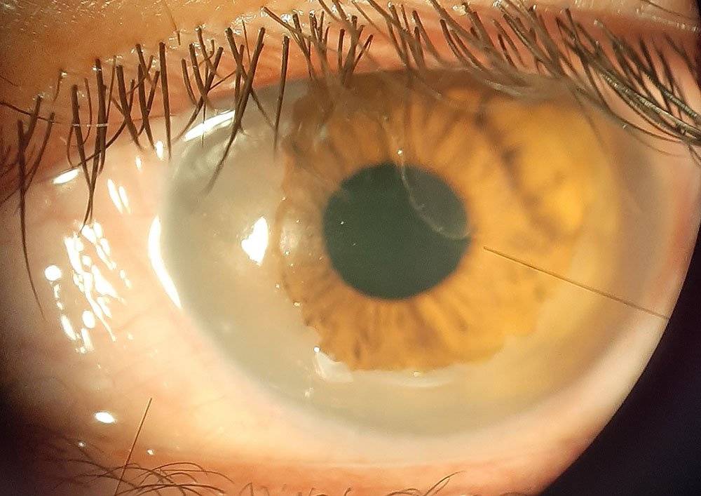 Quemadura corneal