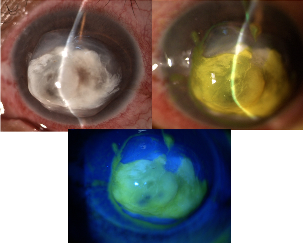 Melting corneal secundario a ulcera micotic