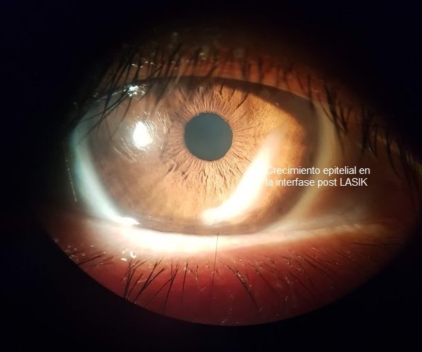 Growing Post LASIK