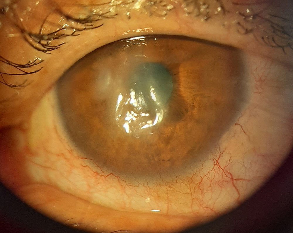 Delen corneal
