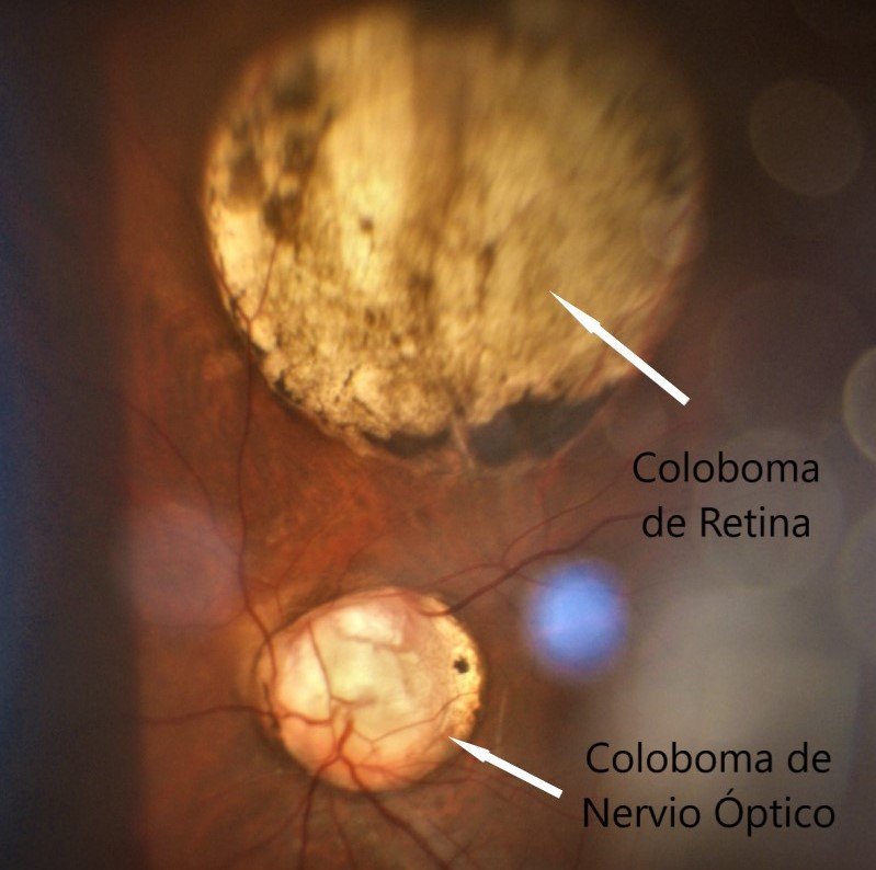 Coloboma de Nervio óptico y retina