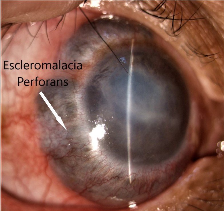 Escleromalacia Perforans