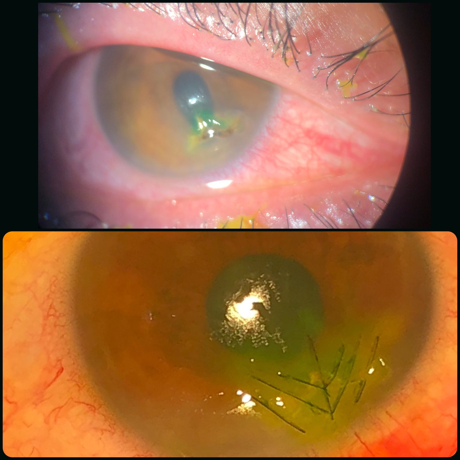Herida corneal anfractuosa