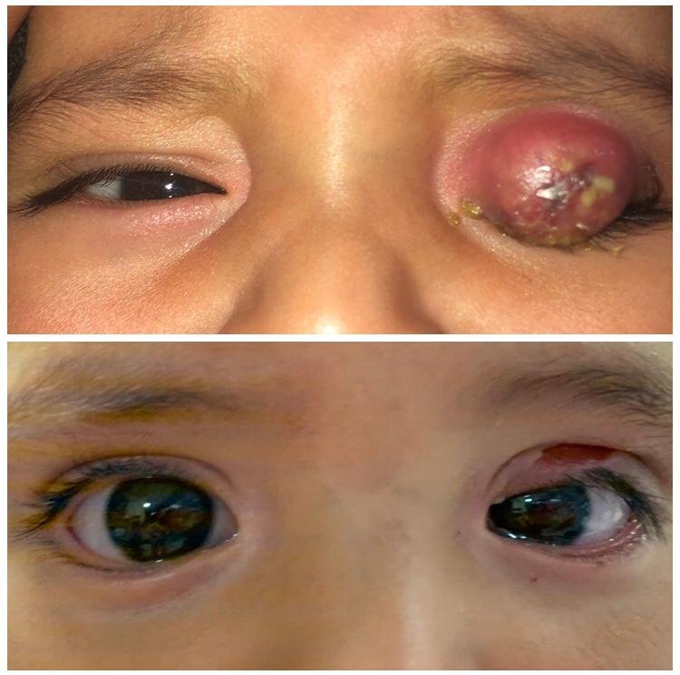Absceso palpebral y esotropia congénita