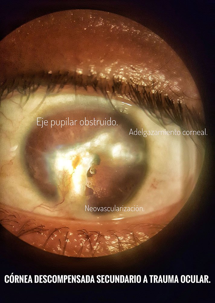 Secuela traumática