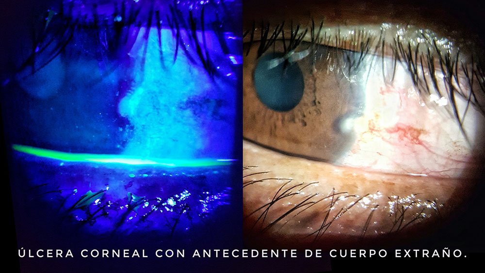 Ala corneal