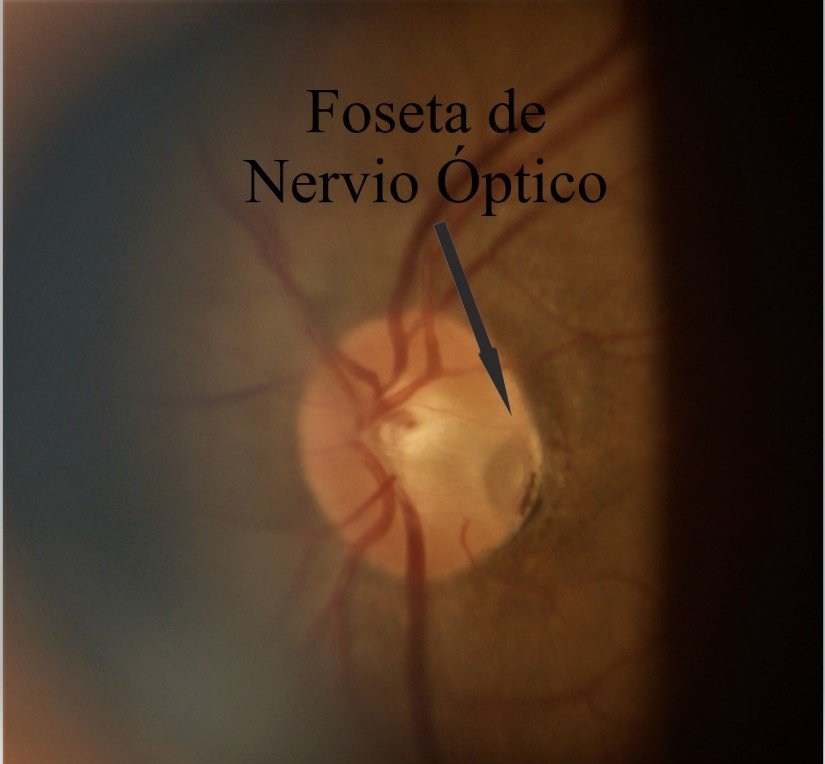 Foseta de Nervio Óptico