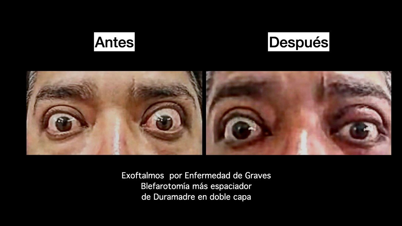 Oculoplástica