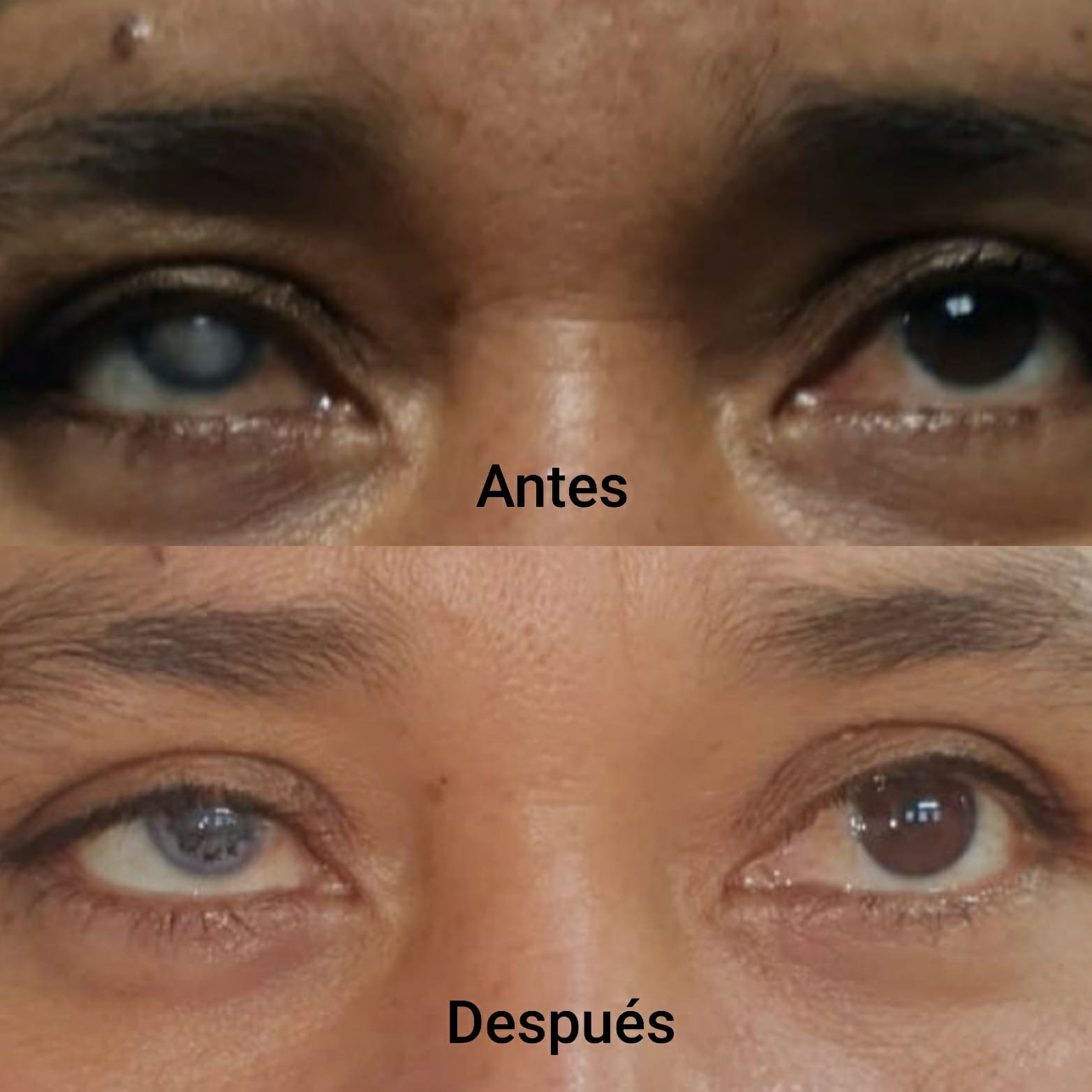 Tatuaje corneal