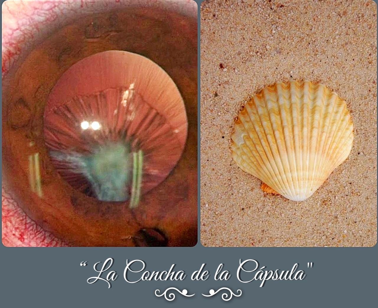 La concha de la capsula