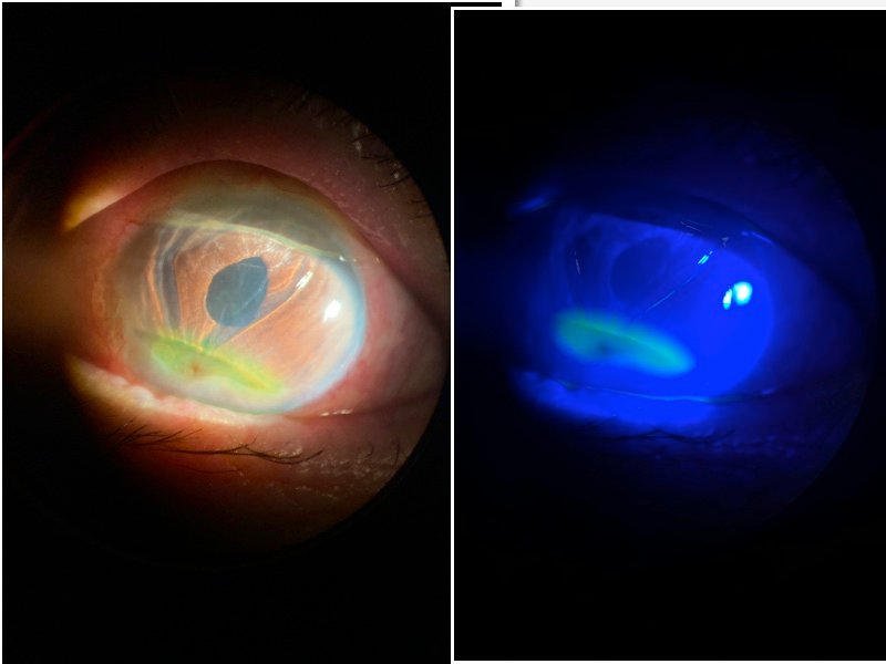 PERFORACIÓN CORNEAL LINEAL