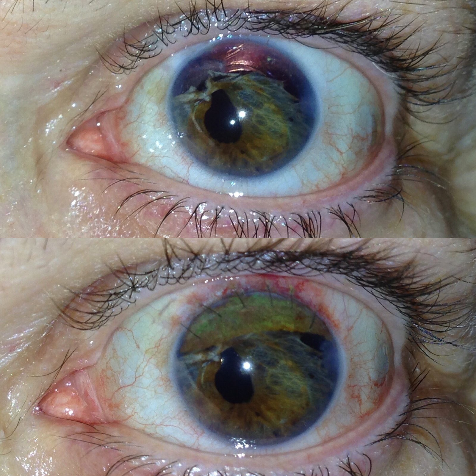 Tatuaje corneal: accesible y efectivo