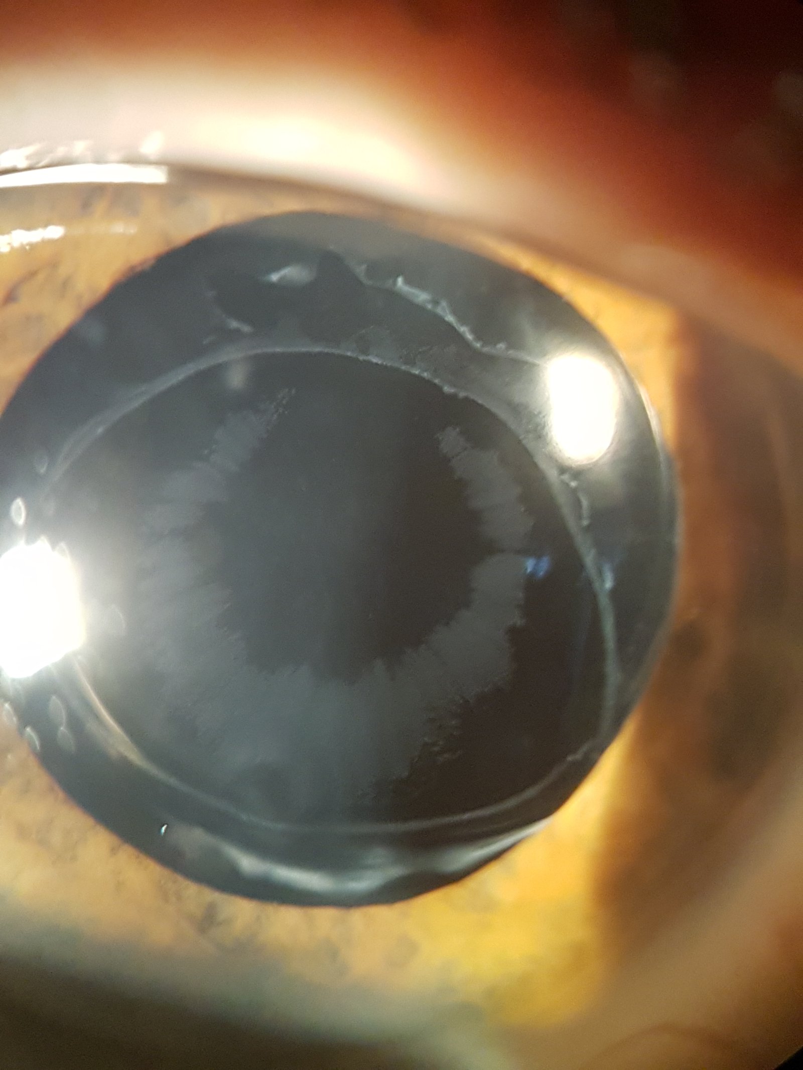 Material de Pseudoexfoliación sobre la lente intraocular