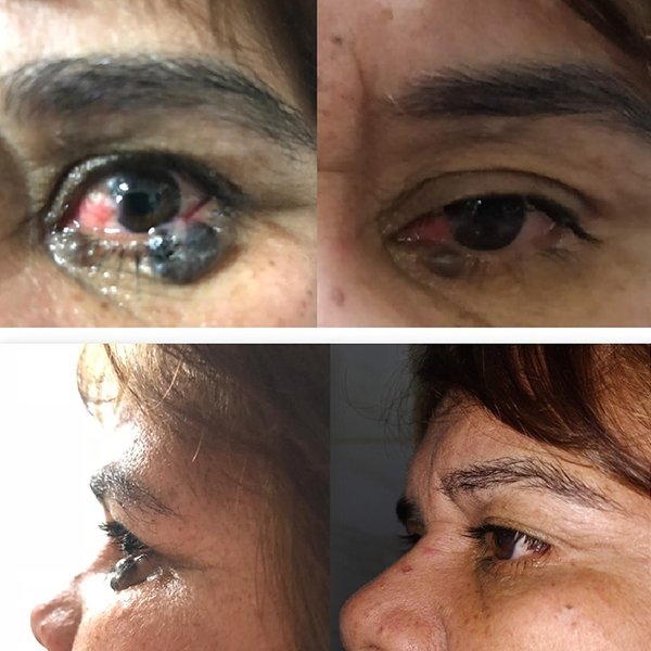 Carcinoma basocelular