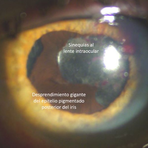 Desprendimiento gigante del epitelio pigmentado posterior del iris