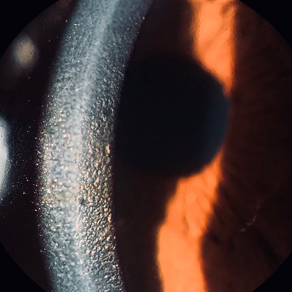 Cornea guttata (beaten metal appearance)