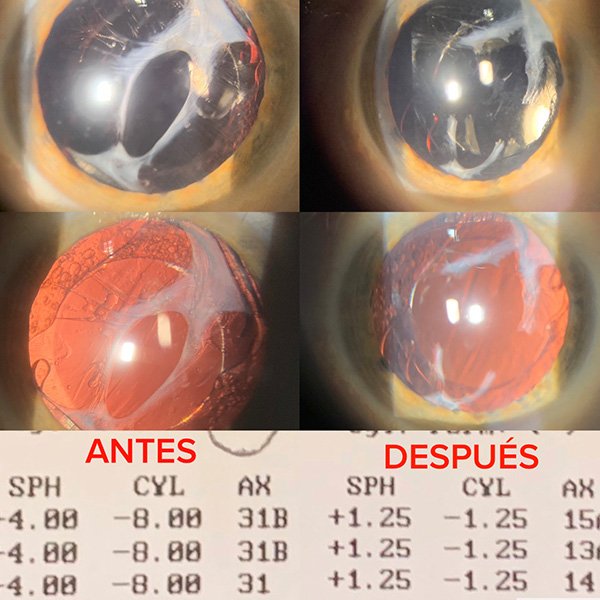 Contracción capsular anterior