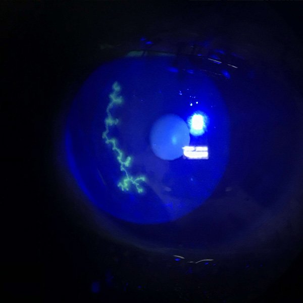 Herpes Simplex Keratitis