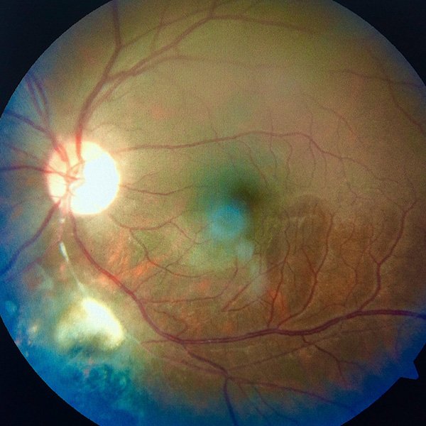 Coriorretinitis
