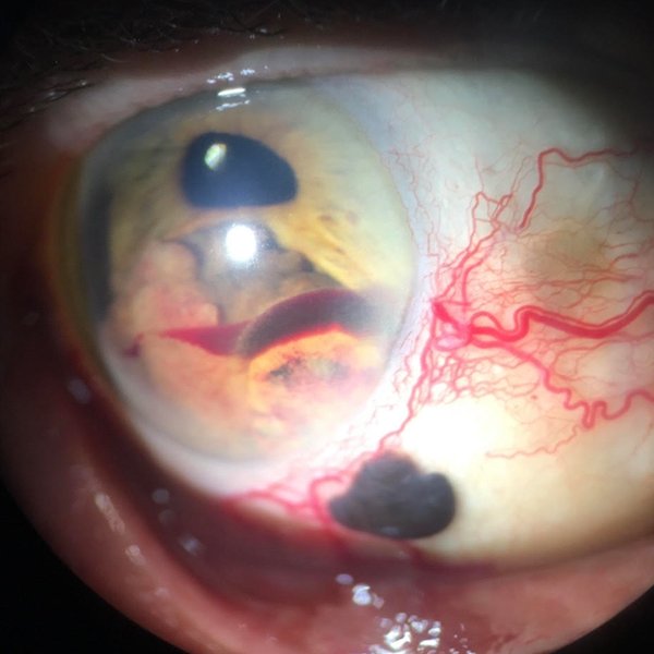 Melanoma Coroideo