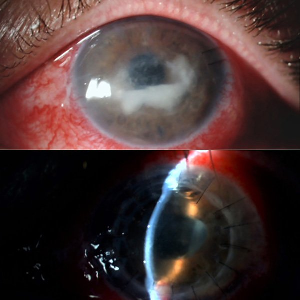 Queratitis fungica de la interfaz postDMEK