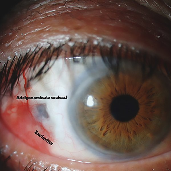 Porfiria cutanea tarda ocular