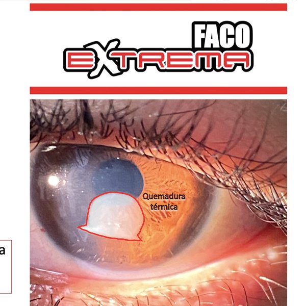 Quemadura Corneal Térmica