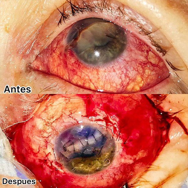 Trauma Ocular