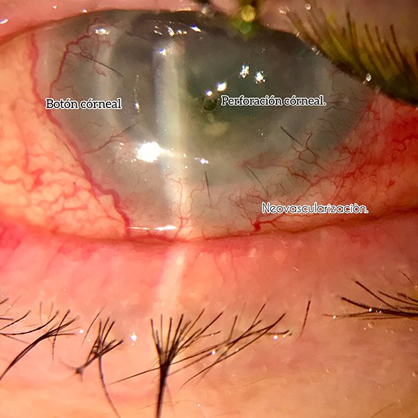 Perforación corneal