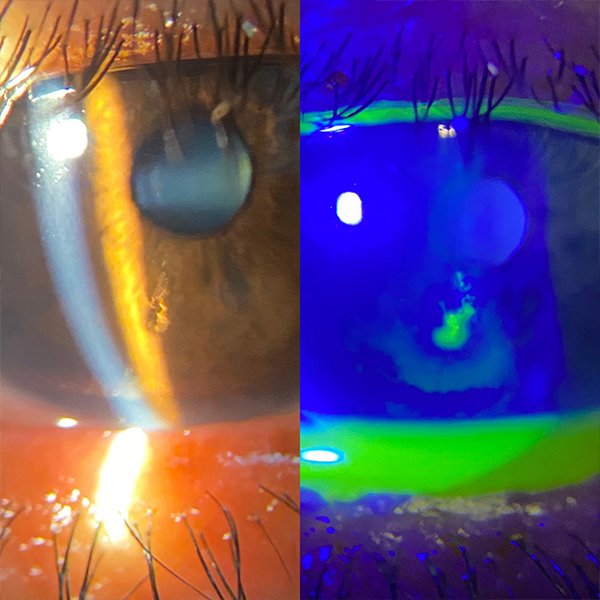 Abrasión Corneal
