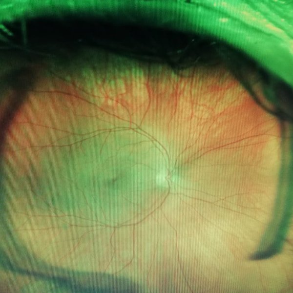 Fondo de ojos