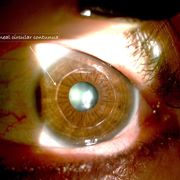 Sutura corneal circular continua