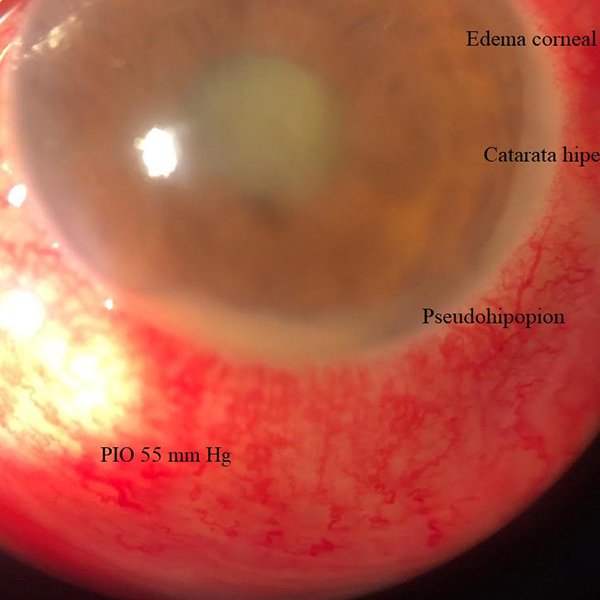 Glaucoma facolítco
