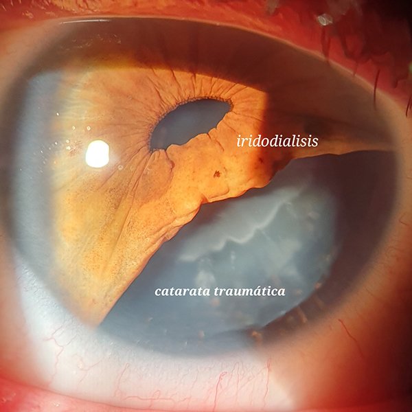 IRIDODIALISIS