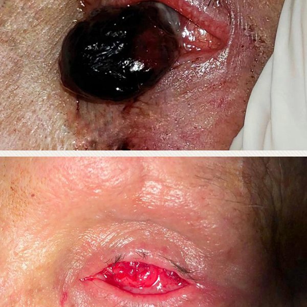 Eclosión Ocular