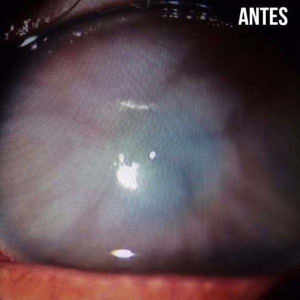Picadura corneal de himenoptero