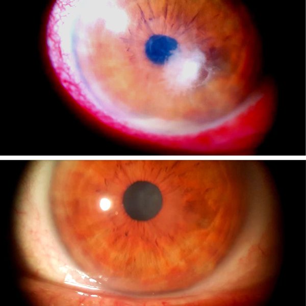 Absceso corneal