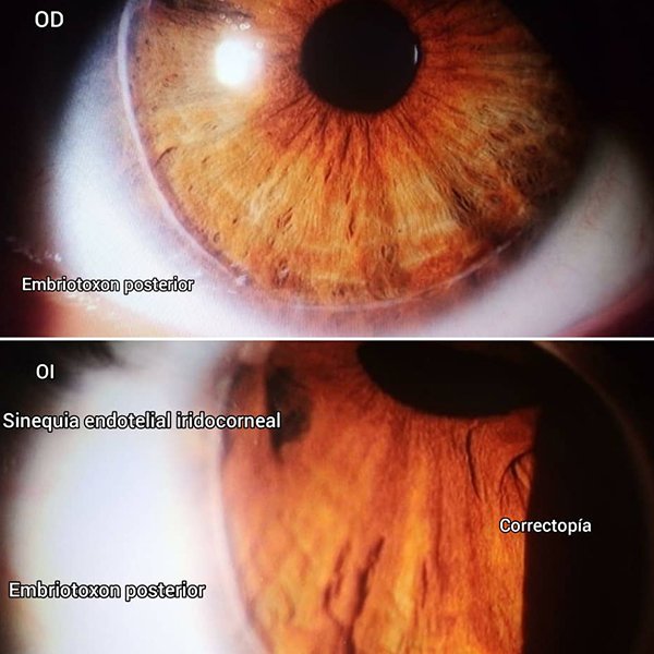 Anomalía de Axenfeld Rieger