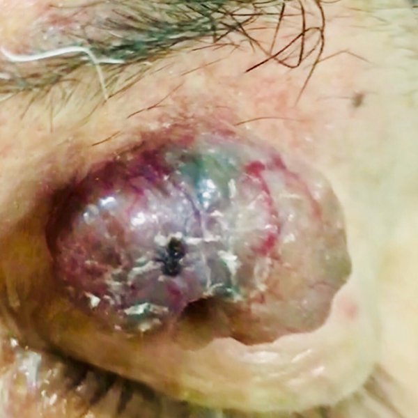 Epitelioma Basocelular