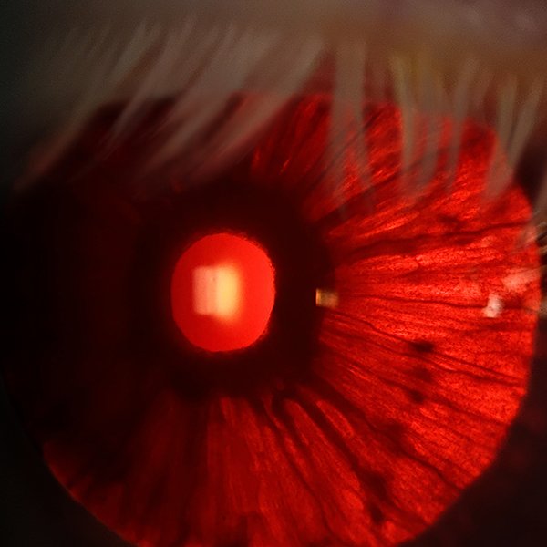 Iris de Persona Albina