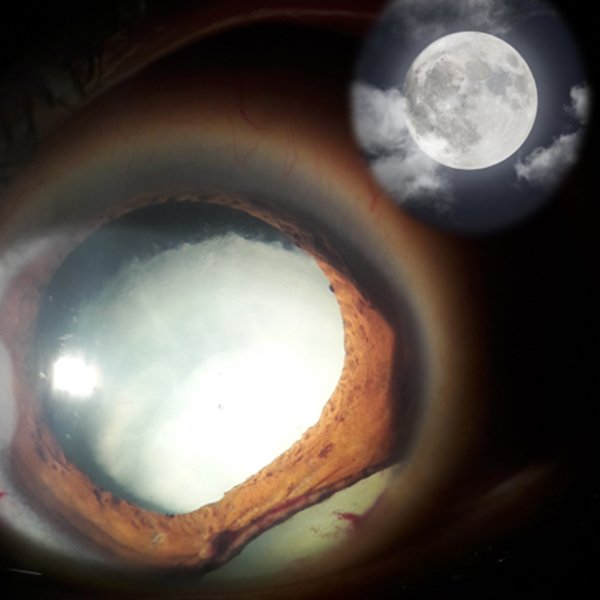 Catarata Lunar