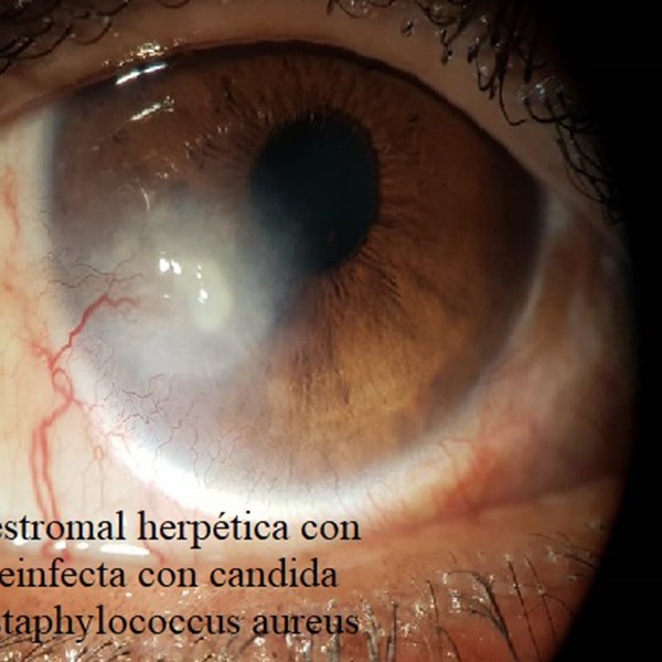 Queratitis estromal con ulceración sobreinfectada