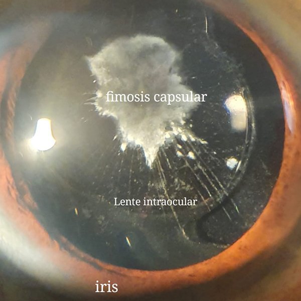 Fimosis capsular