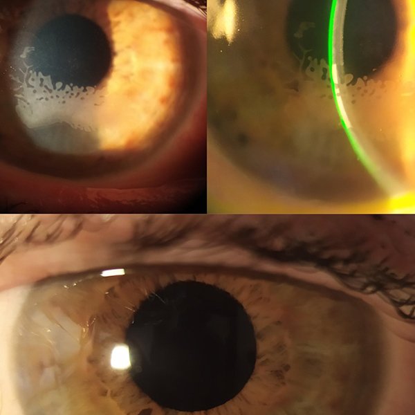 Trauma y Crecimiento epitelial en Lasik