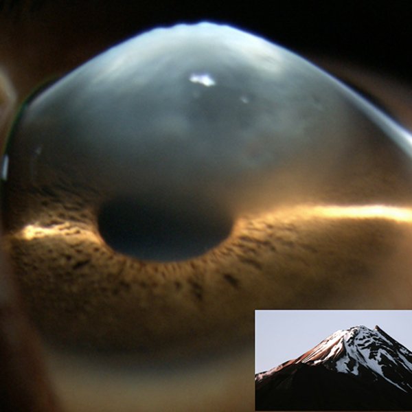 Cornea Snow Sumit